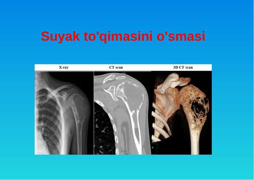 suyak to'qimasini o'smasi