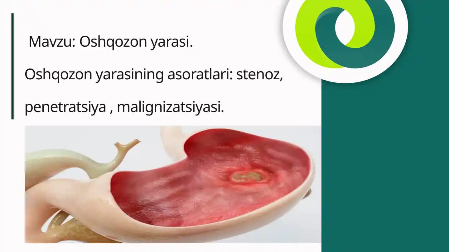 Oshqozonyarasi