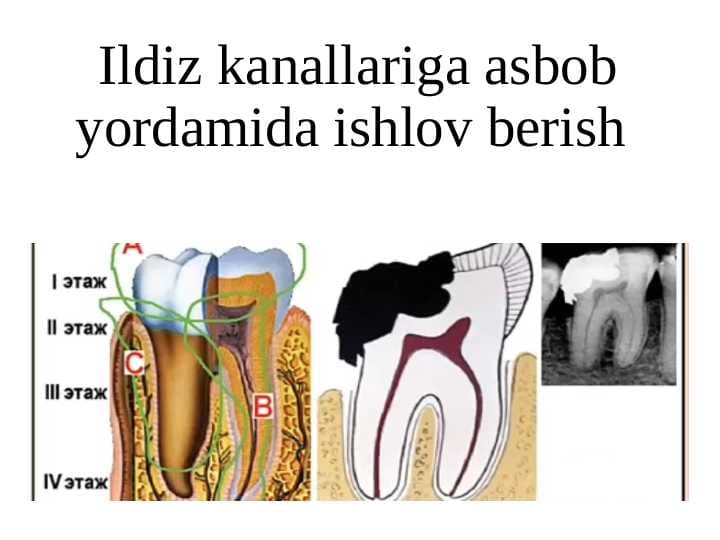 Ildiz kanallariga asbob yordamida ishlov berish