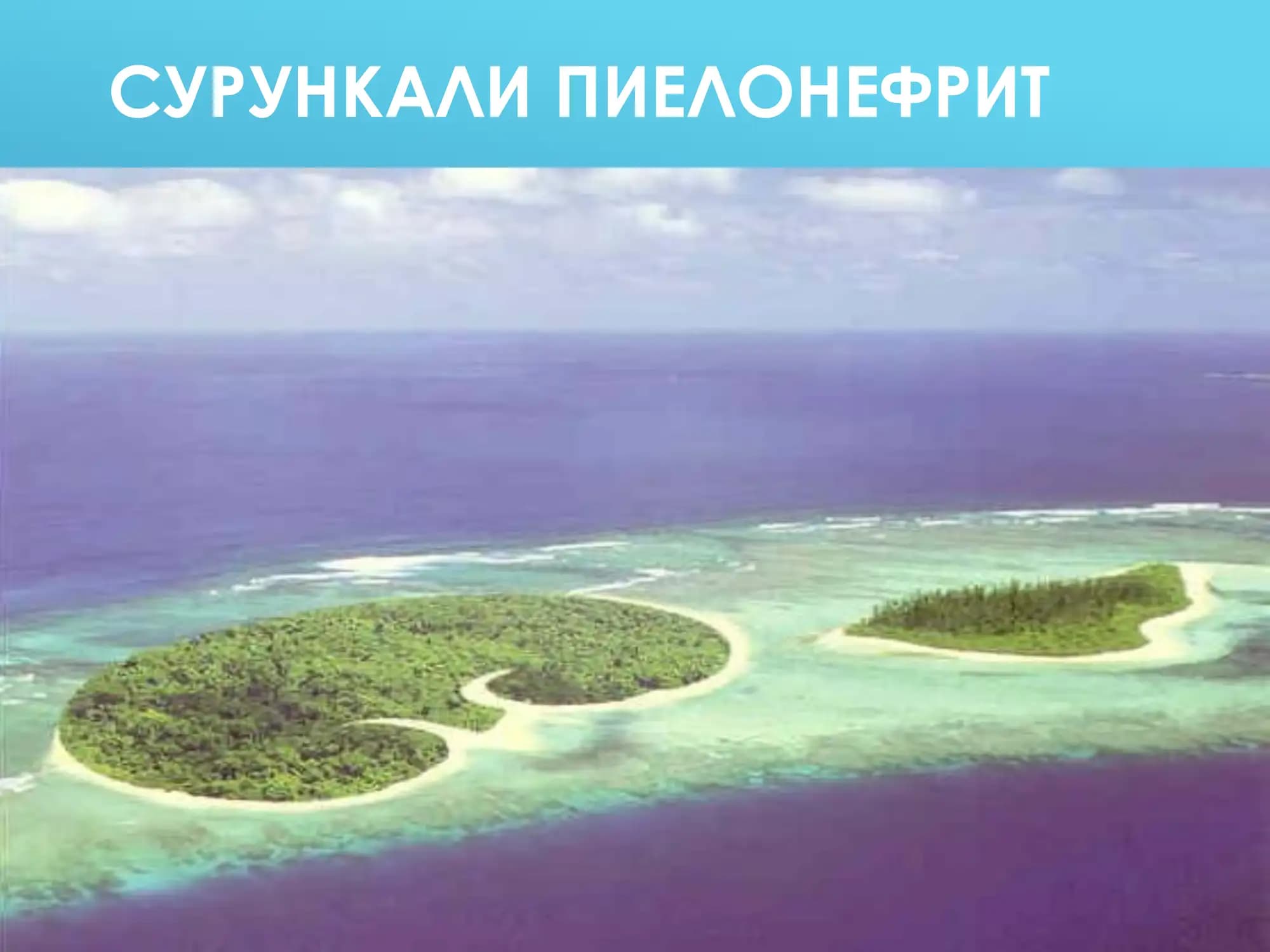 СУРУНКАЛИ ПИЕЛОНЕФРИТ