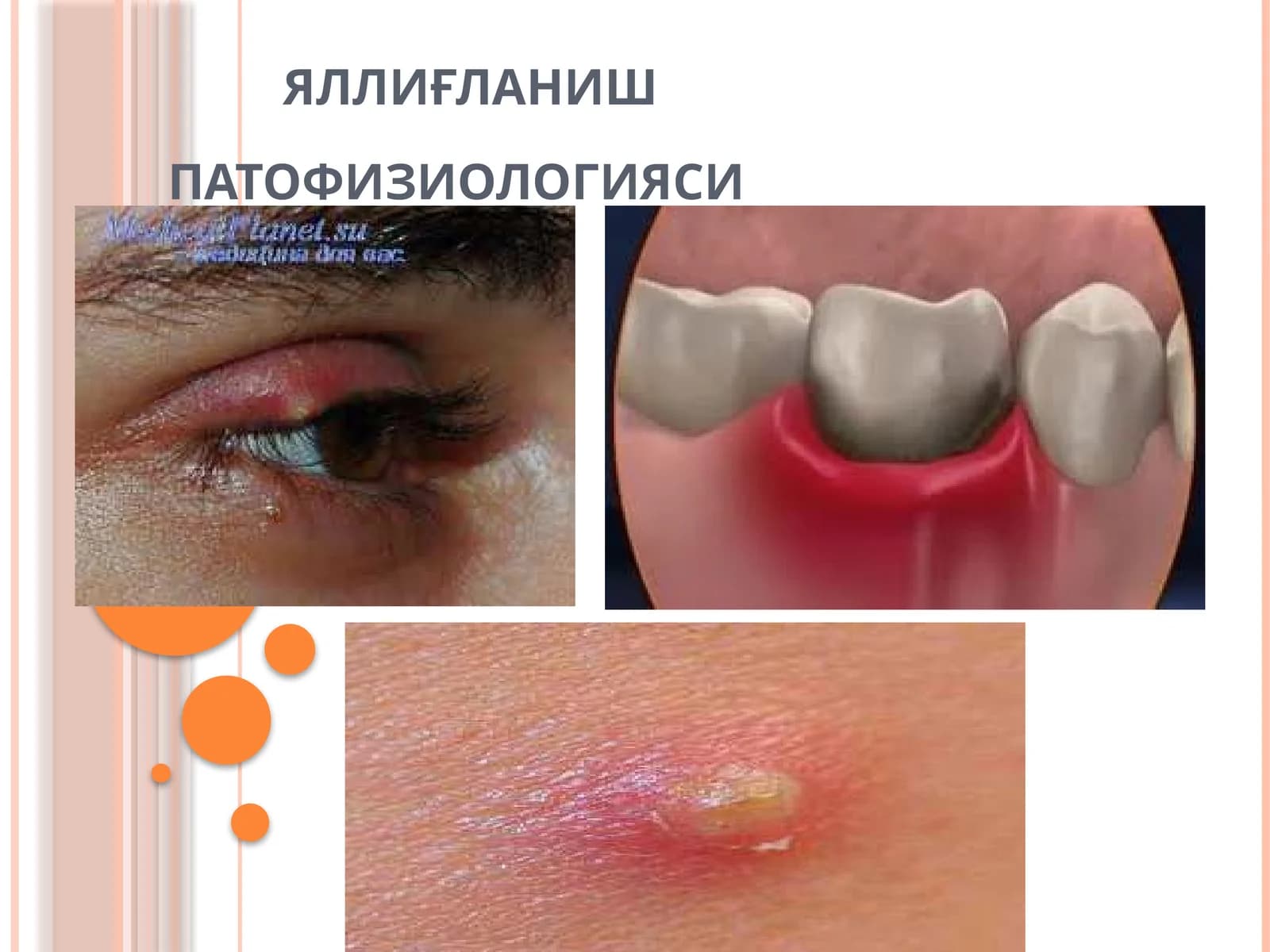 ЯЛЛИҒЛАНИШПАТОФИЗИОЛОГИЯСИ