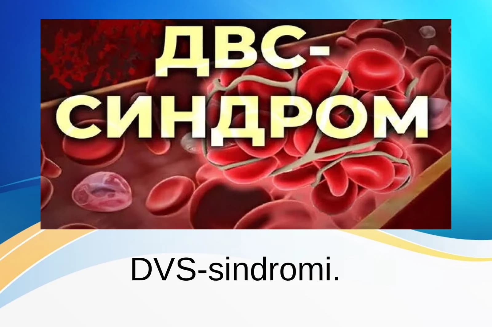 Tromboz, DVS-sindromi, Emboliya patalogik anatomiya.