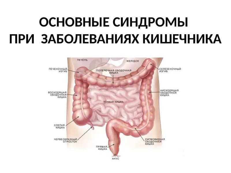 ОСНОВНЫЕ СИНДРОМЫ ПРИ  ЗАБОЛЕВАНИЯХ КИШЕЧНИКА