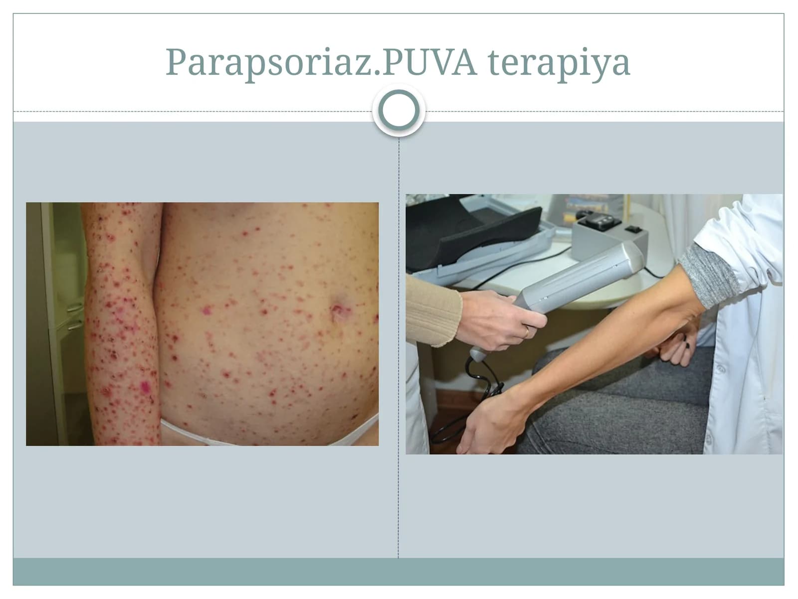 Parapsoriaz.PUVAterapiya
