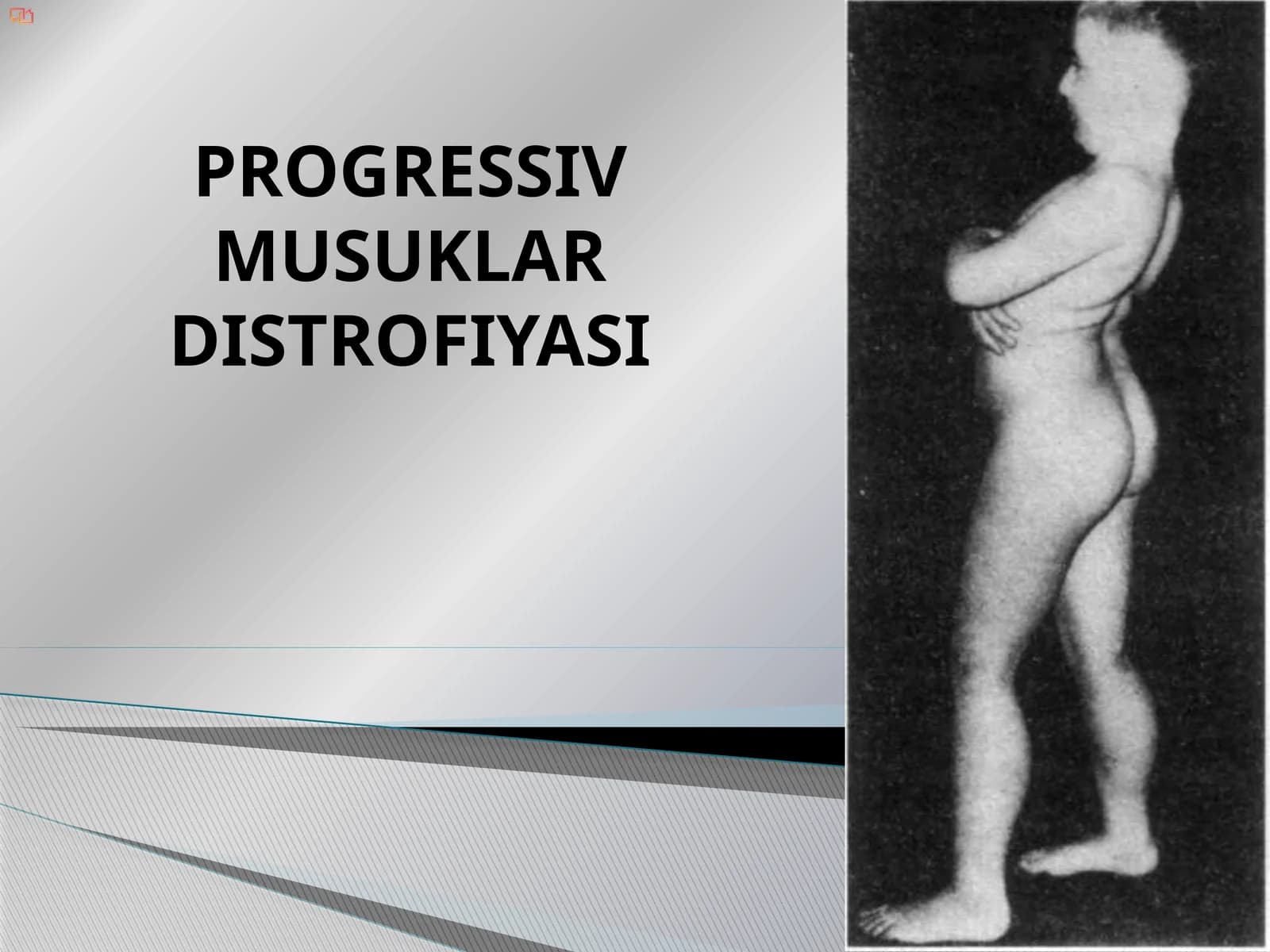 PROGRESSIV MUSUKLAR DISTROFIYASI