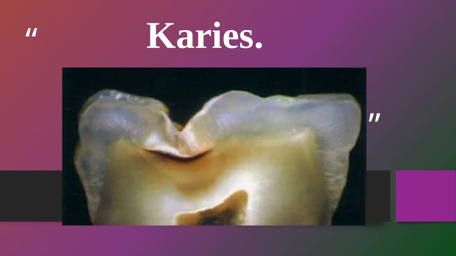 Karies