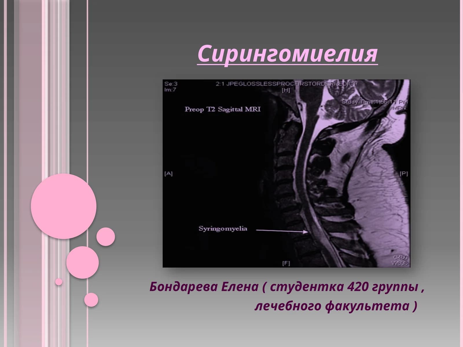 Сирингомиелия