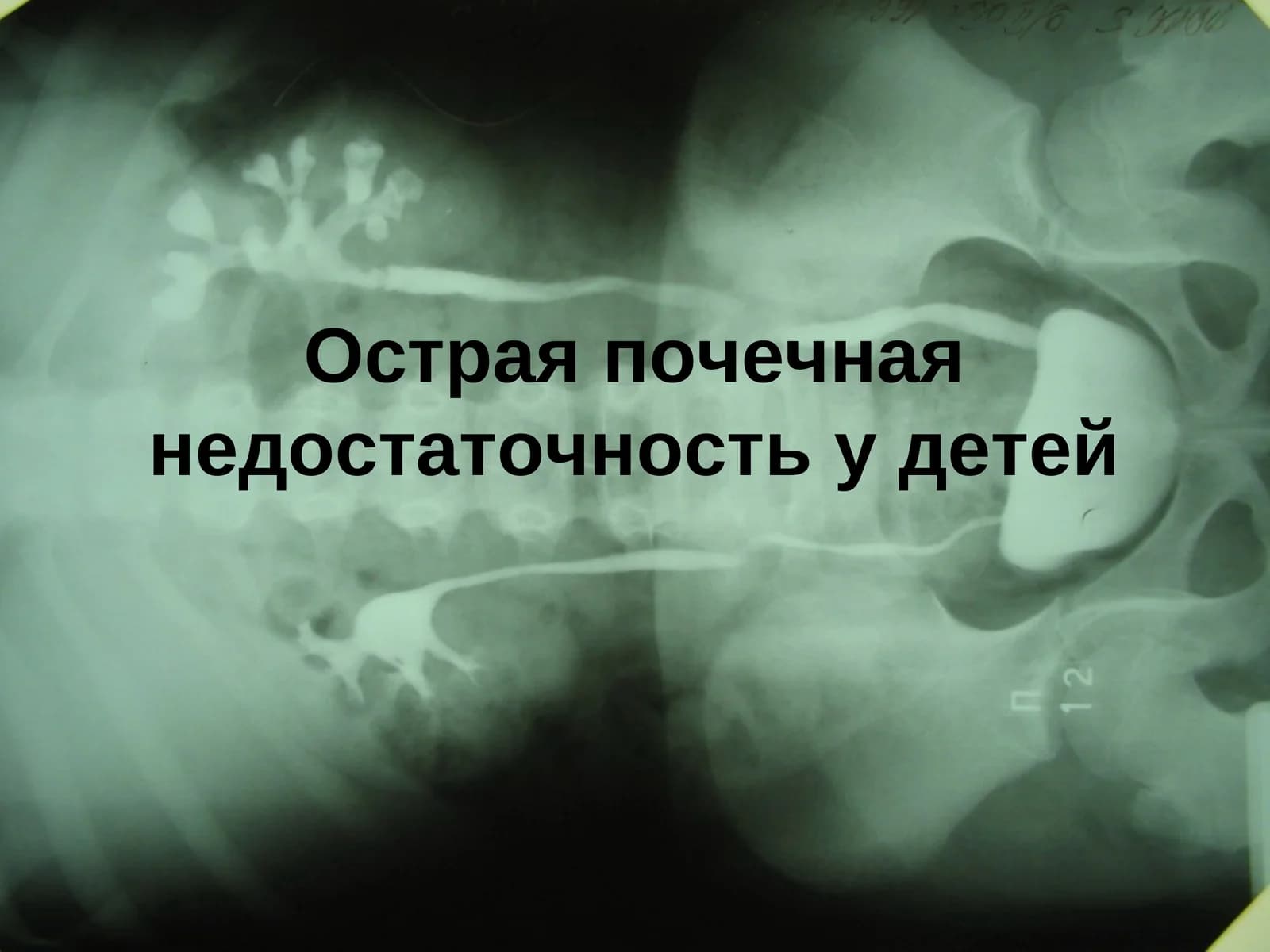 Острая почечная недостаточность у детей