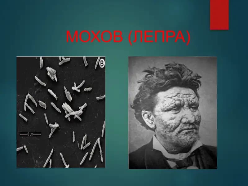 МОХОВ (ЛЕПРА)