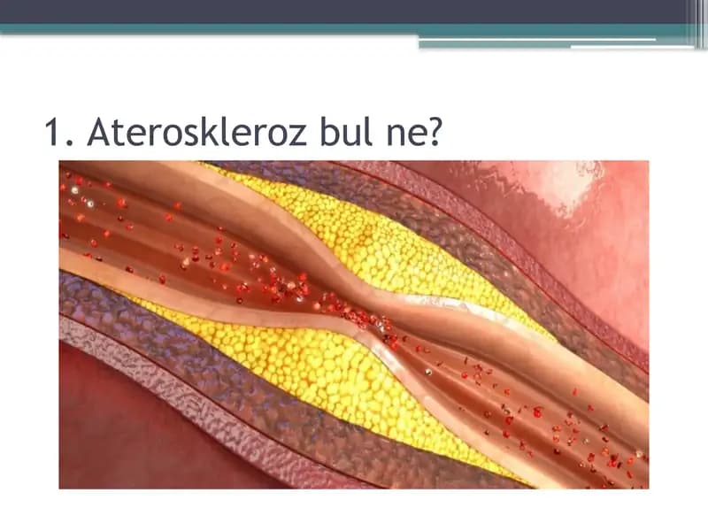 Ateroskleroz