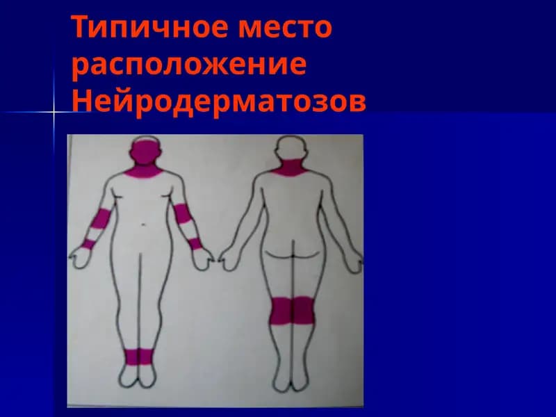 Нейродермит