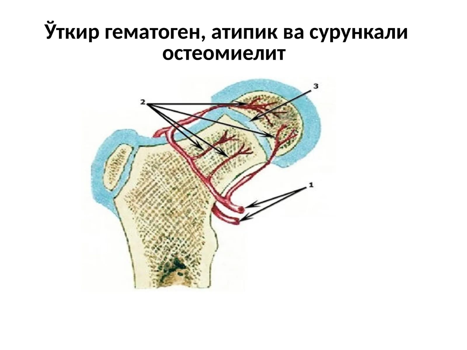 Уткир гематоген, атипик ва сурункали остеомиелитv - osteomiyelit