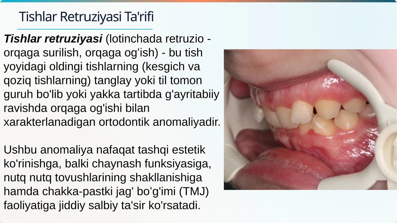 Tishlar retruziyasi