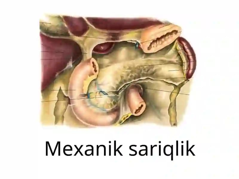 Mexanik sariqlik