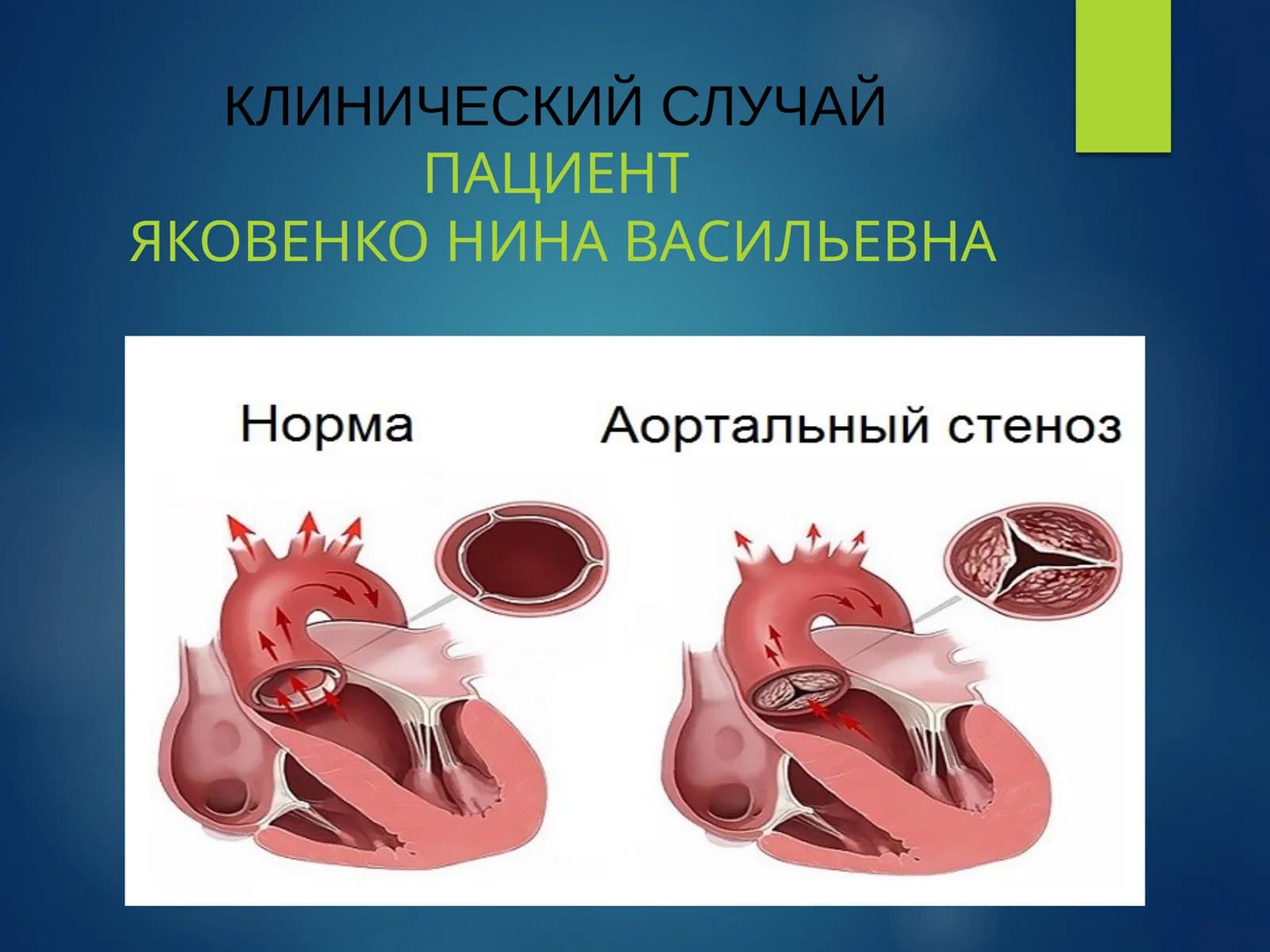 КЛИНИЧЕСКИЙ СЛУЧАЙПАЦИЕНТЯКОВЕНКО НИНА ВАСИЛЬЕВНА