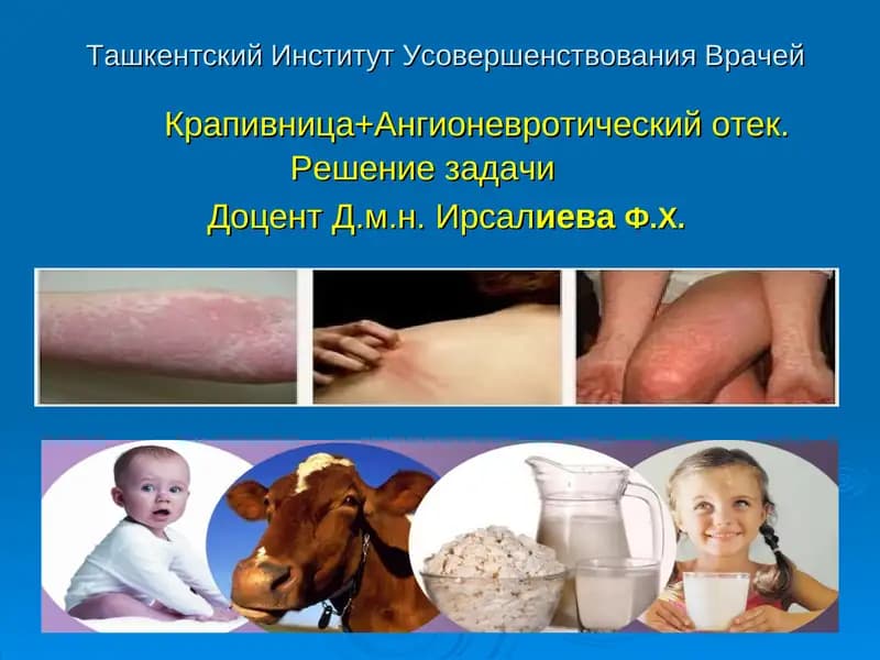 Крапивница