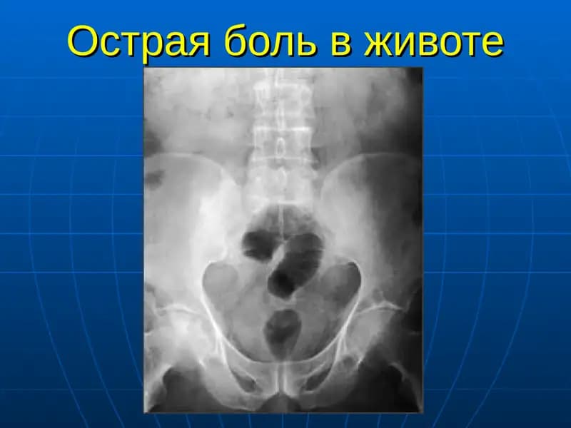 Острая боль в животе