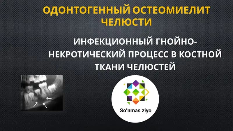 Одонтогенный остеомиелит челюсти