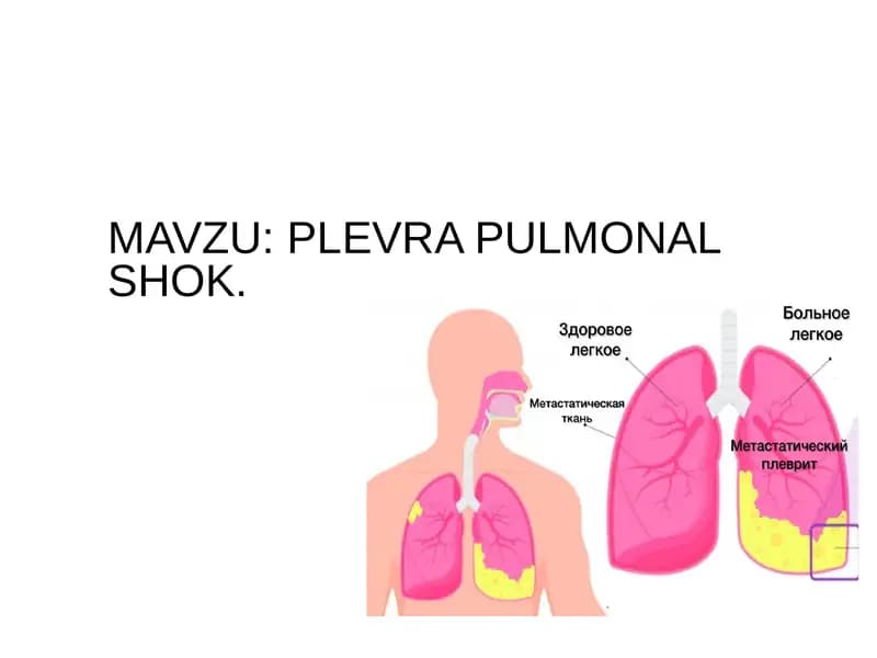 Plevra  pulmonal shok