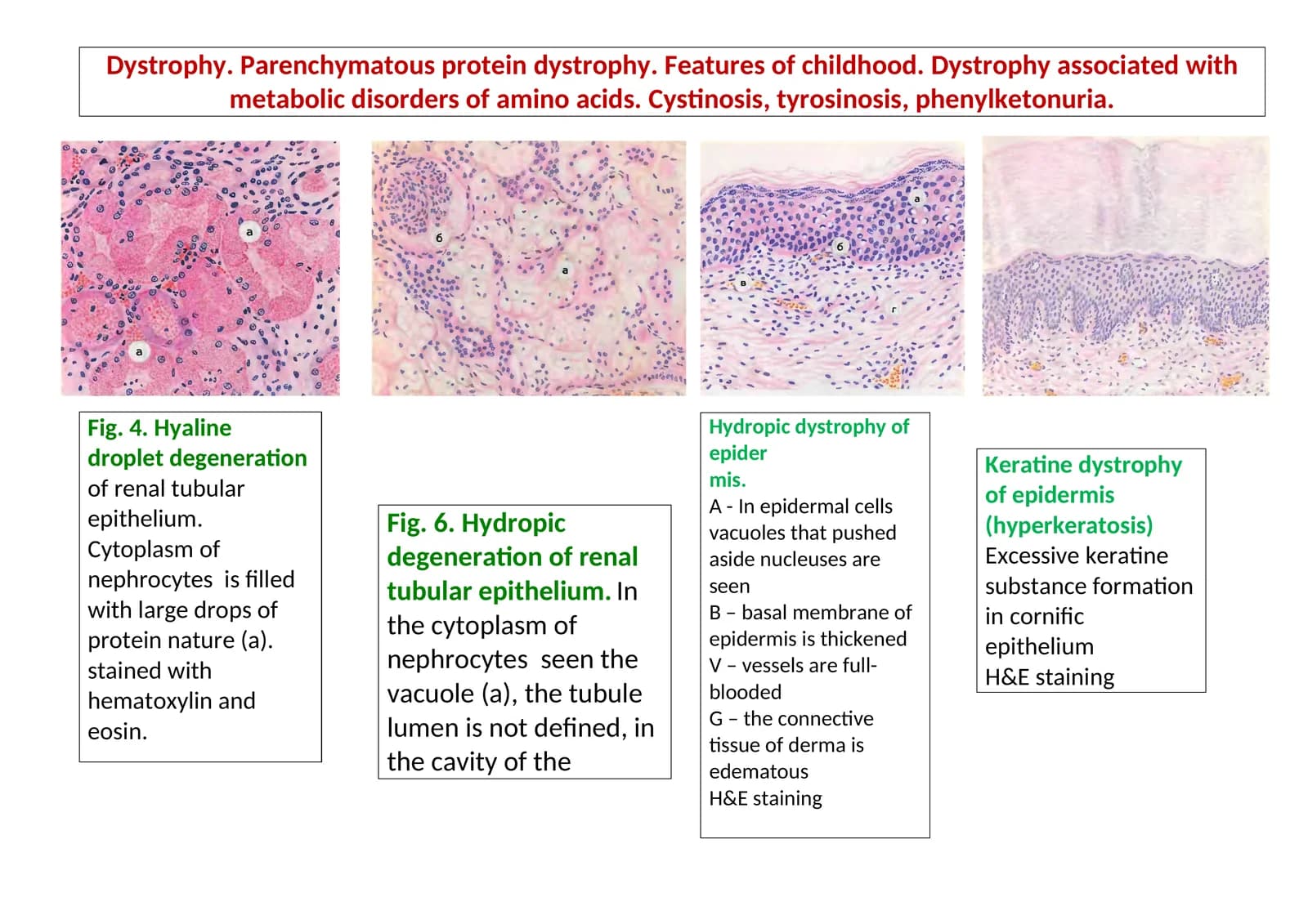 Hydropic dystrophy of epidermis