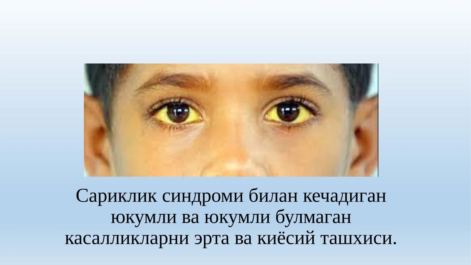 Сариклик синдроми