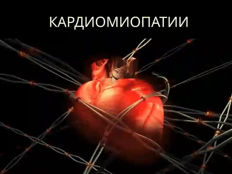 КАРДИОМИОПАТИИ