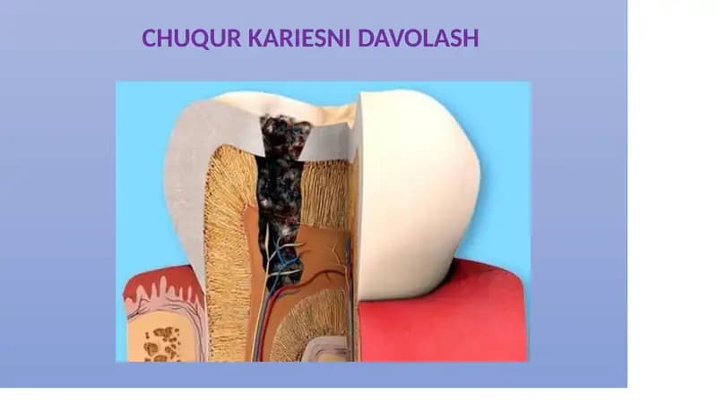 CHUQUR KARIESNI DAVOLASH