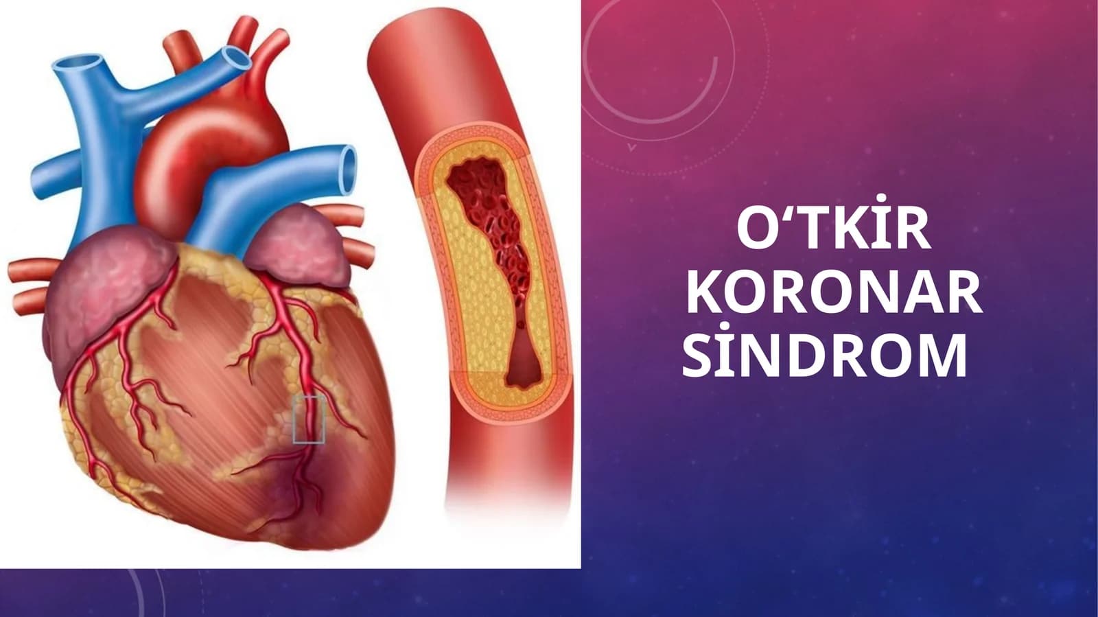 O‘tkir koronar sindrom