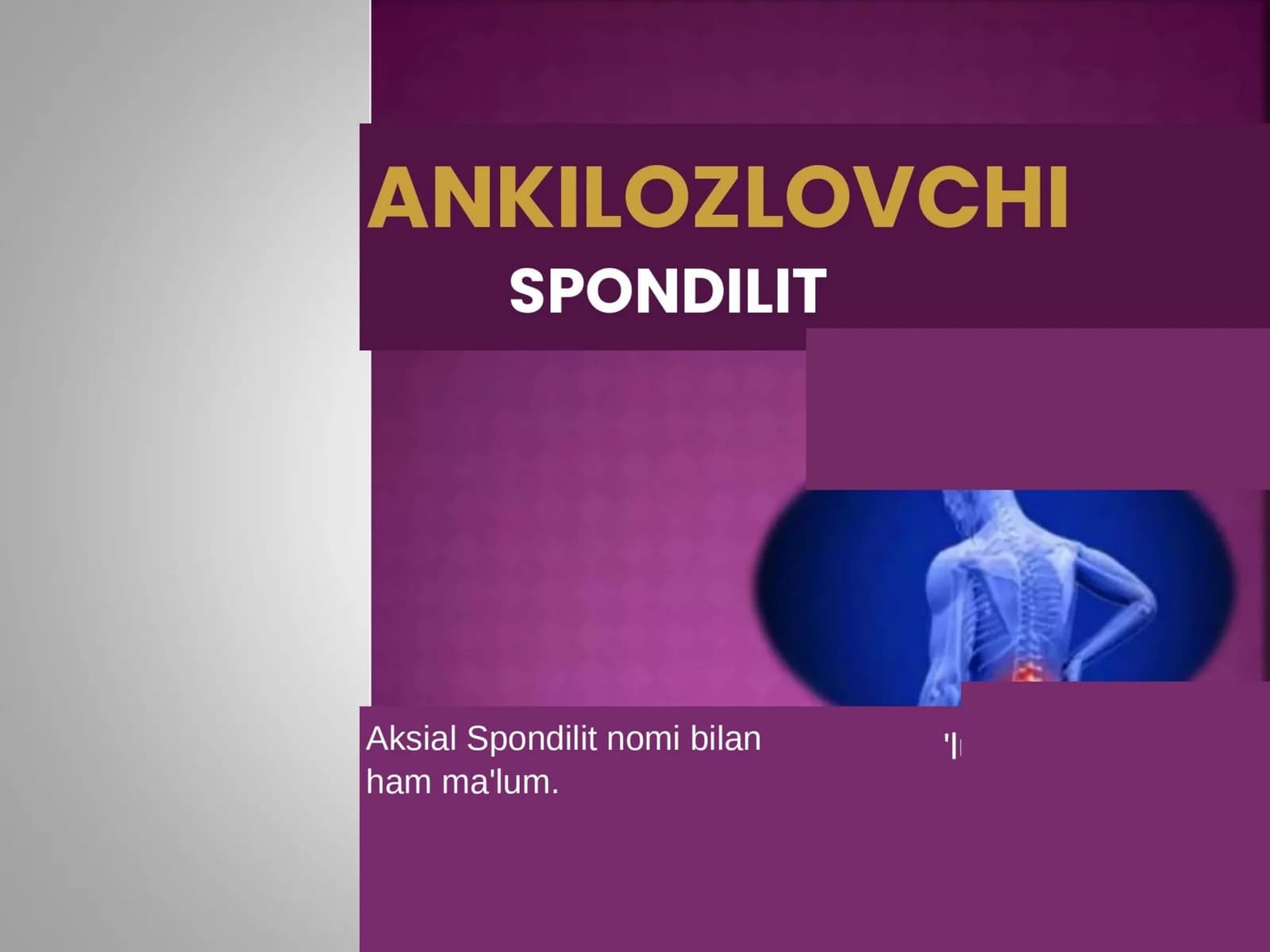 Ankilozlovchi Spondilit