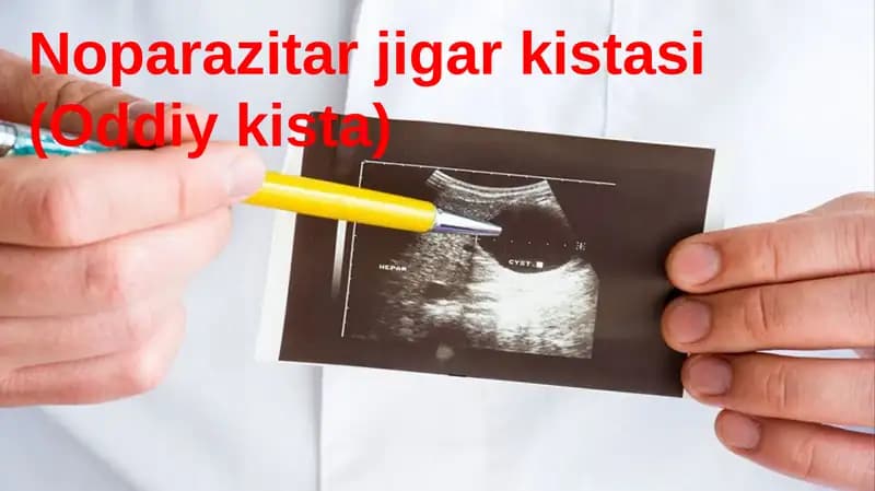 Noparazitar jigar kistasi