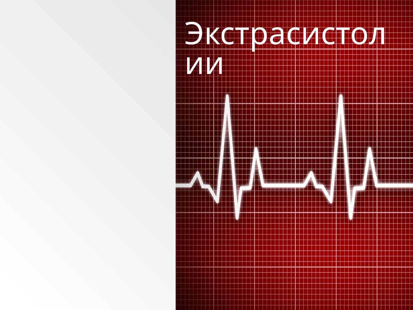 Экстрасистолии