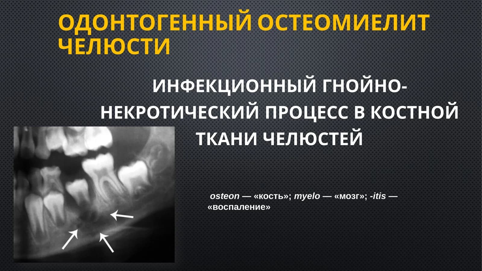 Одонтогенныйостеомиелитчелюсти