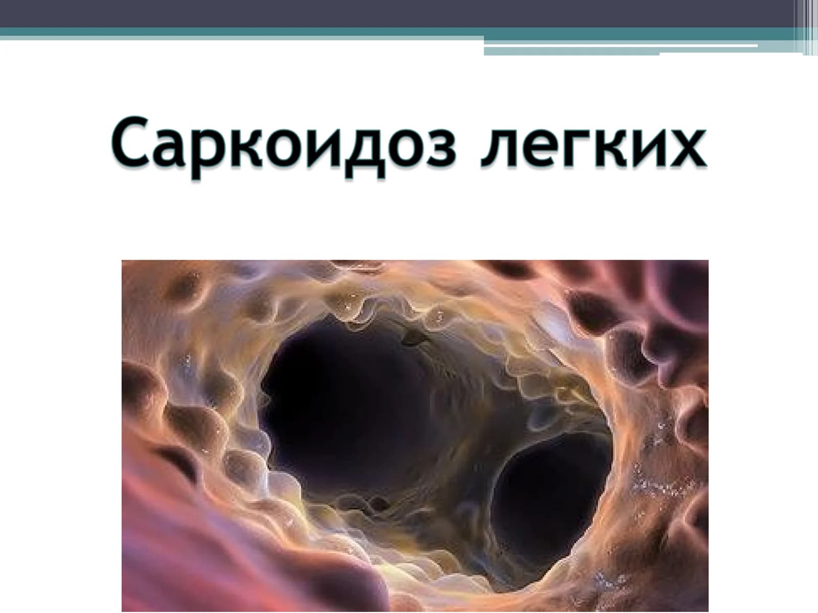 Саркоидоз легких (болезнь Бенье-Бека-Шауманна)
