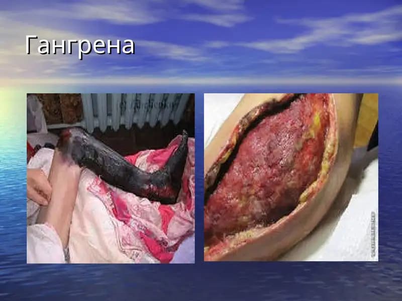 gangrena