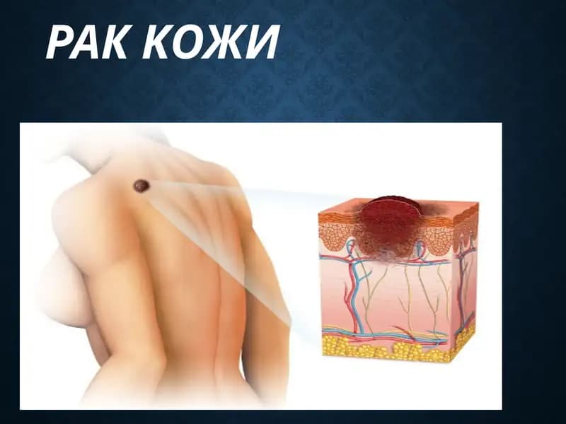 Рак кожи