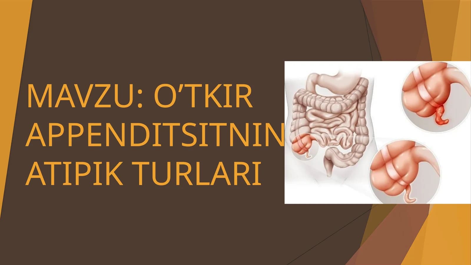 O’TKIR APPENDITSITNING ATIPIK TURLARI