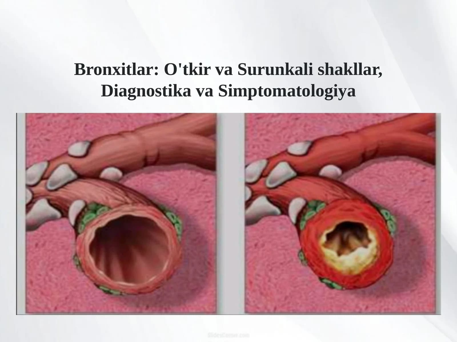 Bronxitlar: O'tkir va Surunkali shakllar, Diagnostika va Simptomatologiya