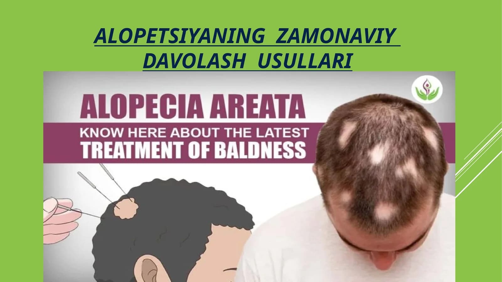 ALOPETSIYANING ZAMONAVIY DAVOLASH USULLARI