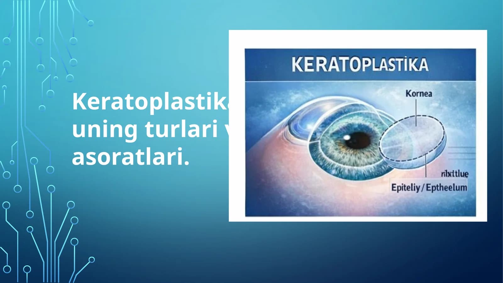 Keratoplastika, uning turlari va asoratlari