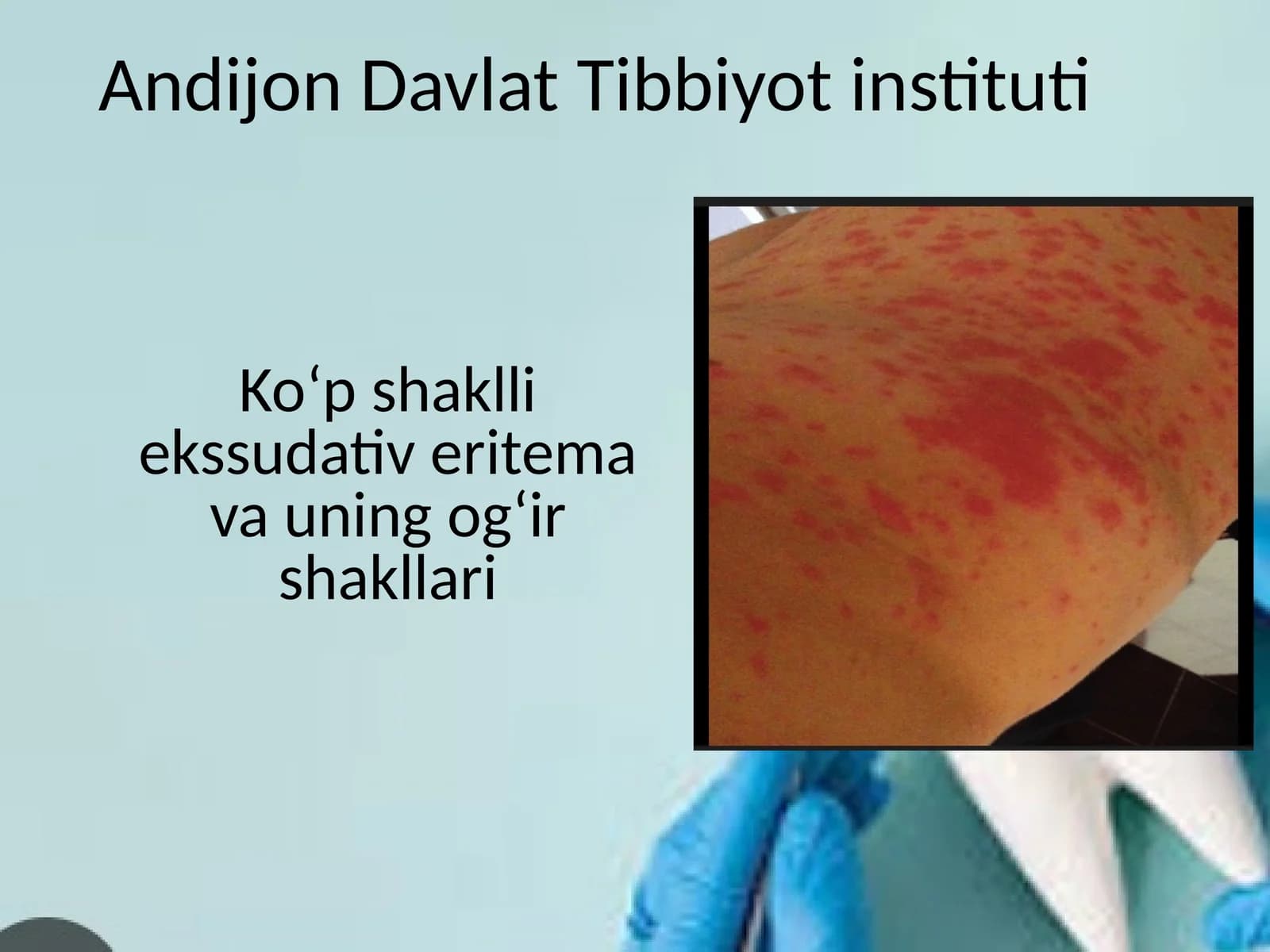 Ko‘p shaklli ekssudativ eritema va uning og‘ir shakllari