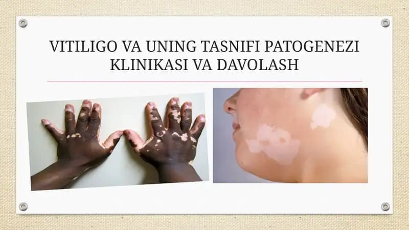 VITILIGO VA UNING TASNIFI PATOGENEZI KLINIKASI VA DAVOLASH