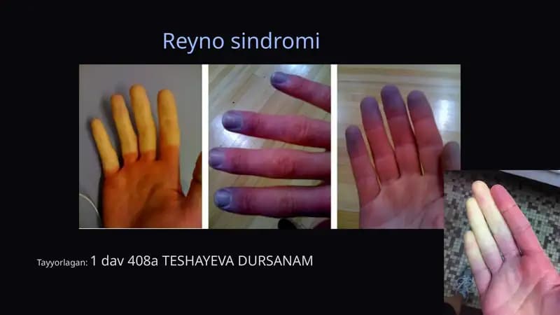 Reyno sindromi