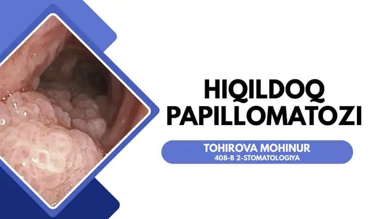 Hiqildoq papillomasi