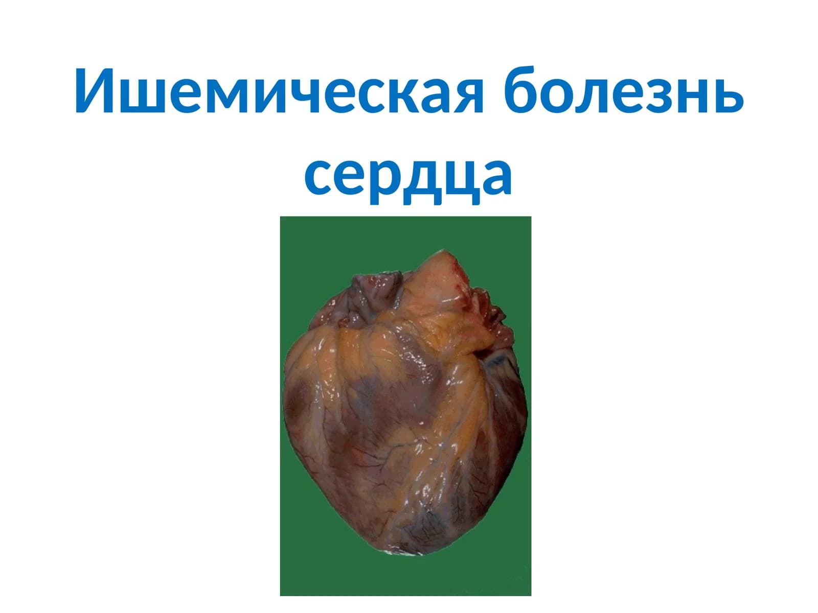 Ишемическая болезнь сердца