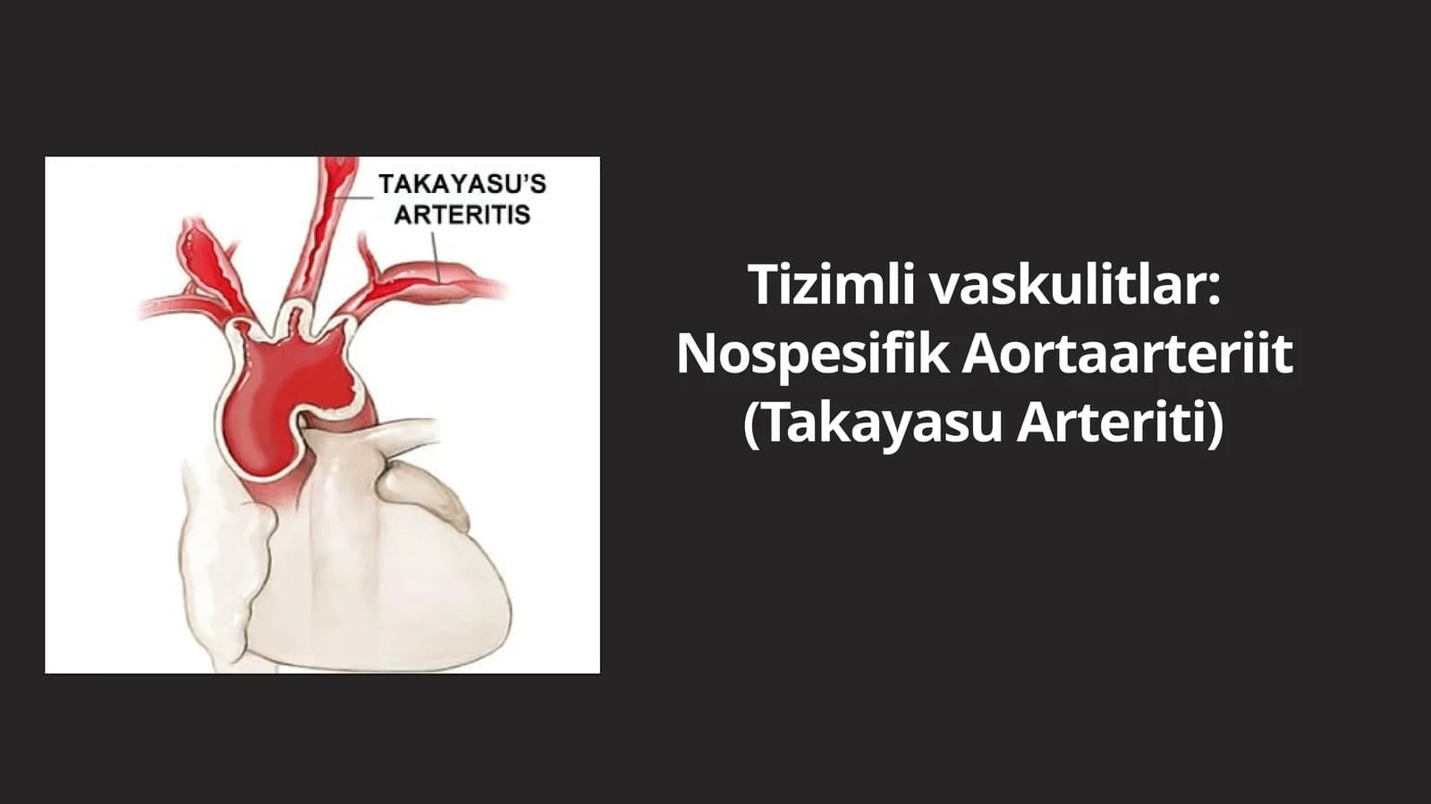 Takayasu Arteriti