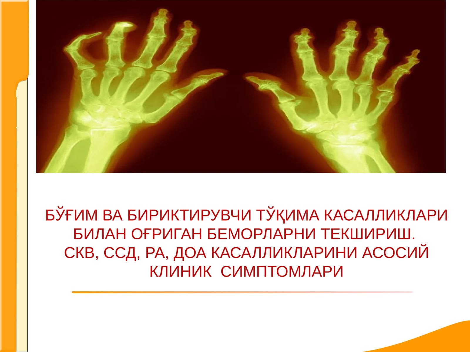 Системали кизил волчанка