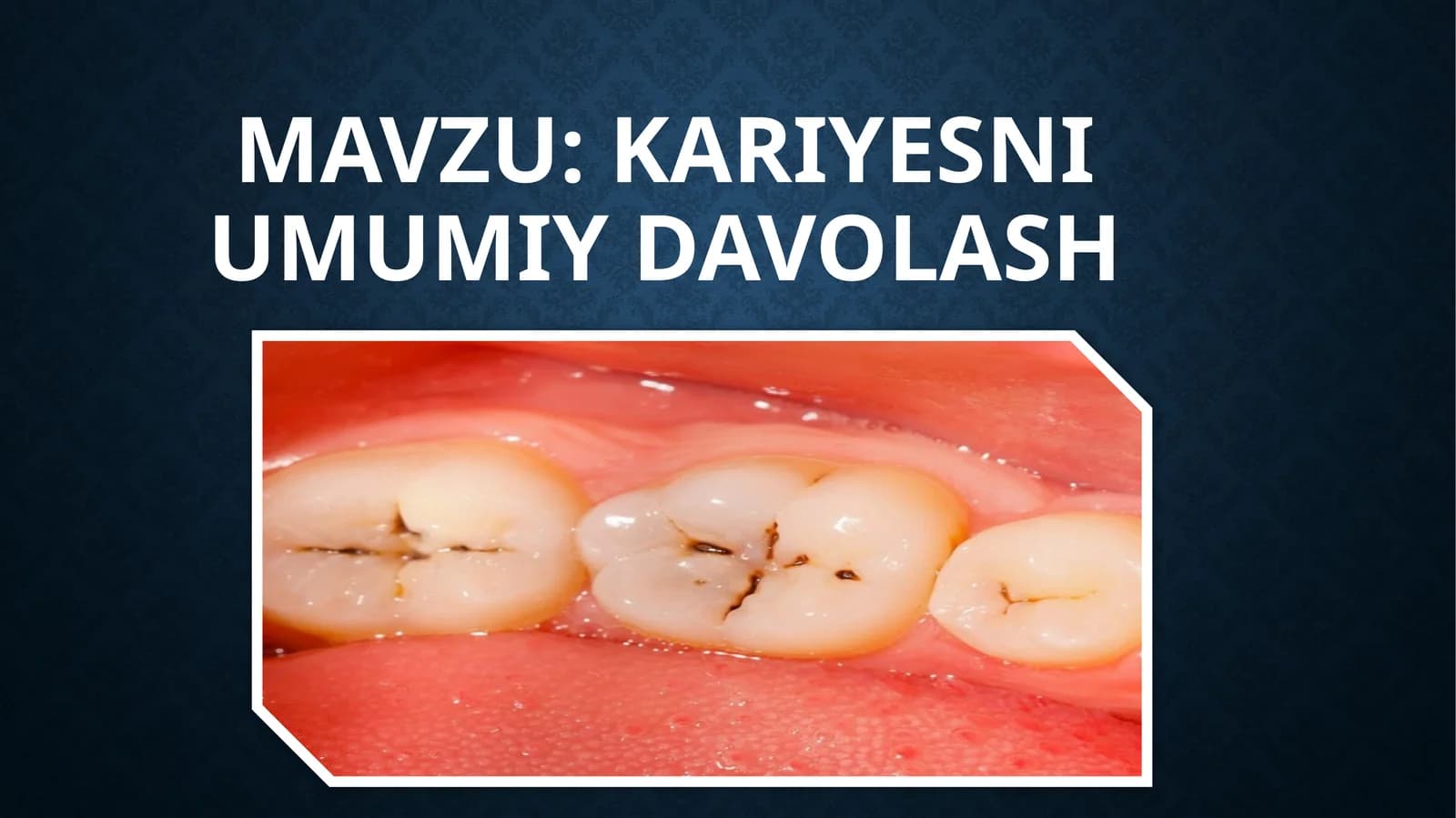 Kariesni umumiy davolash