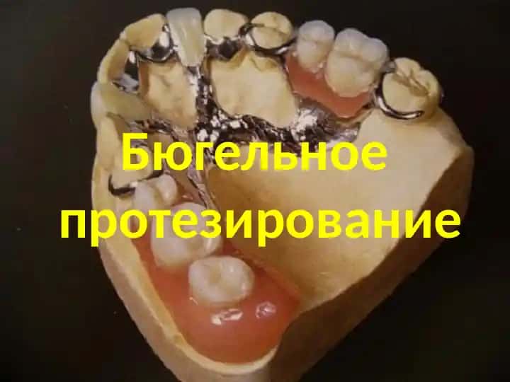 Бюгельное протезирование