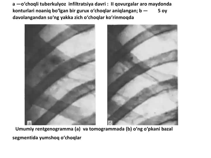 O'choqli tuberkulyoz Infiltratsiya davri