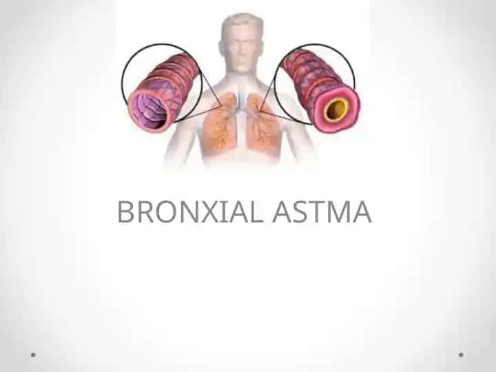 BRONXIAL ASTMA